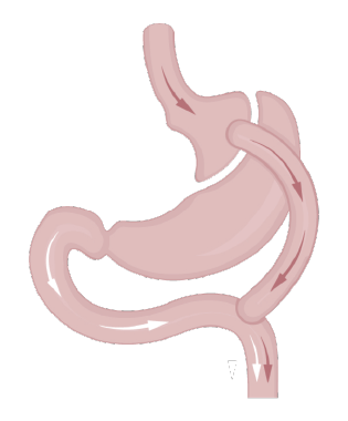 Ilustración de bypass gástrico