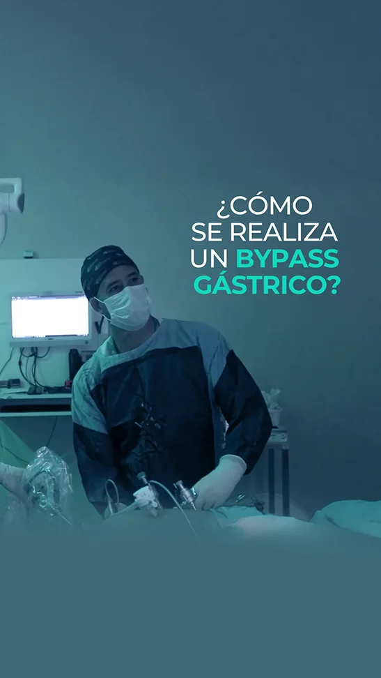¿Cómo se realiza un bypass gástrico?